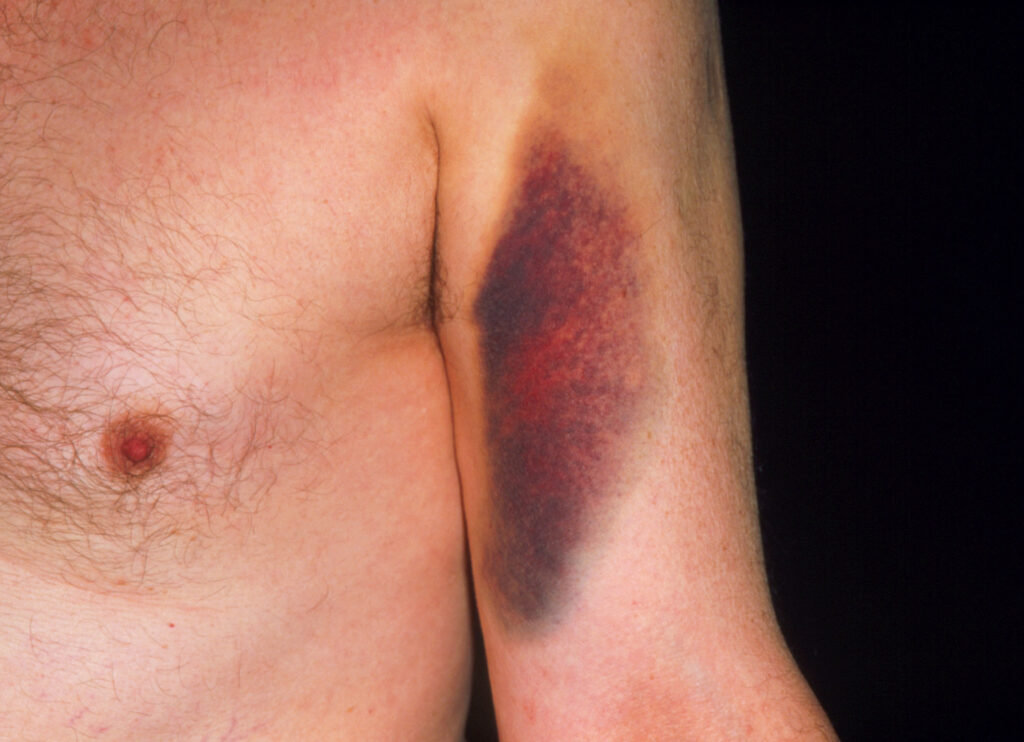 Bruising caused by warfarin.