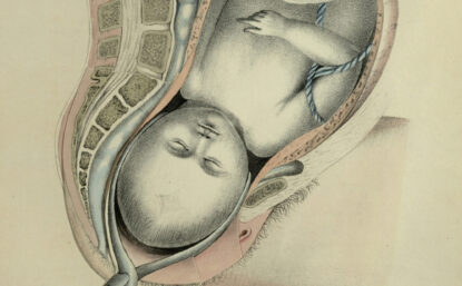 Anatomical drawing of a baby in the womb being removed with forceps.
