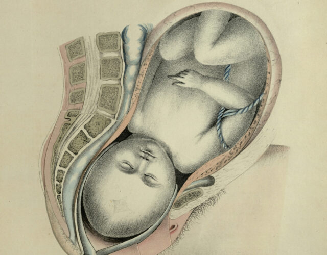 Anatomical drawing of a baby in the womb being removed with forceps.