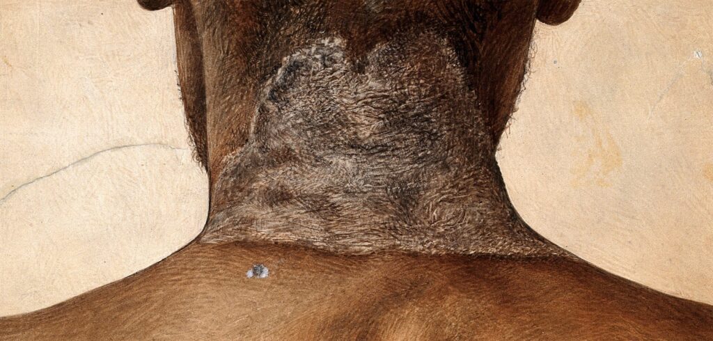Illustration of a lesion on the back of a man's neck