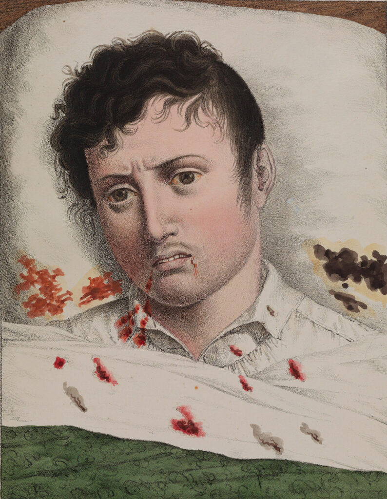 Yellow Fever 1793 Eyes