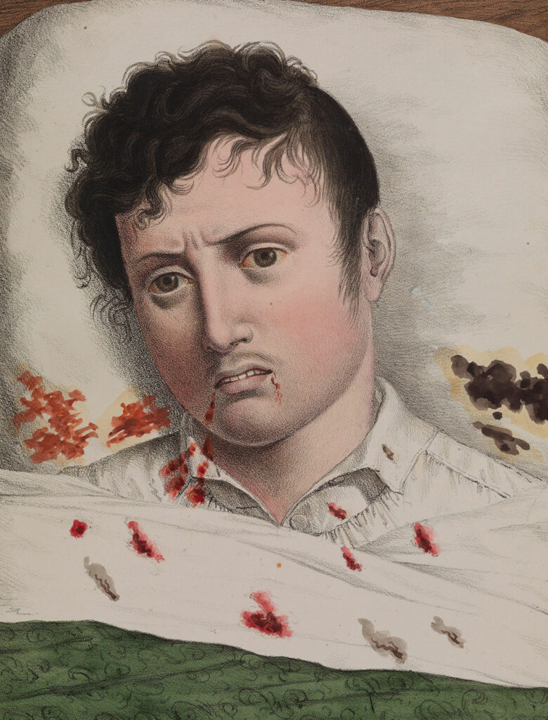 color lithograph of sick man
