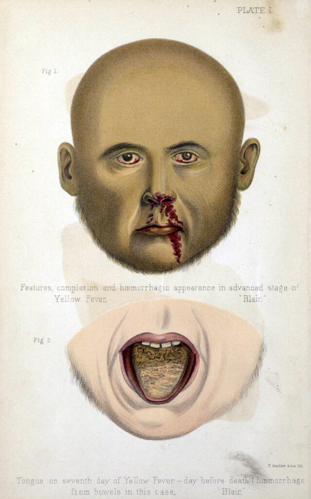 Color illustrations showing a jaundiced man with a bloody nose and a mouth with a diseased tongue