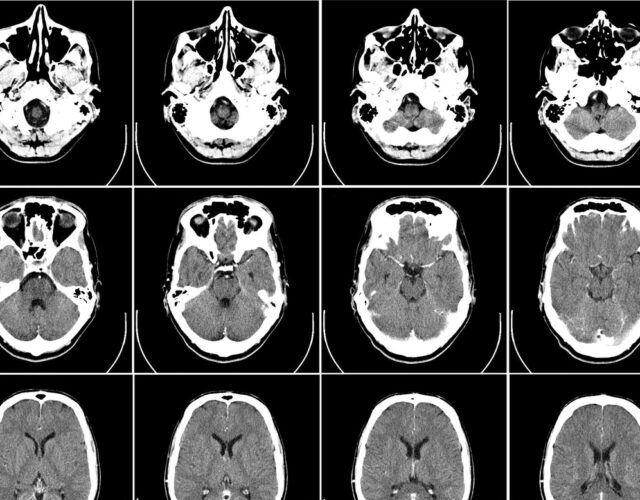 Black and white grid of brain scans. Computer tomography of human brain, from base of the skull to top.